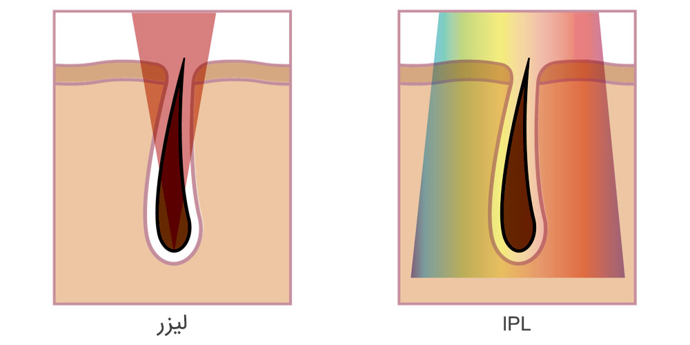 تفاوت تکنولوژی اصلاح نوری (IPL) و لیزر